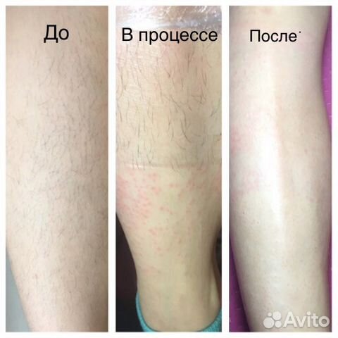 Электроэпиляция Электроэпиляция