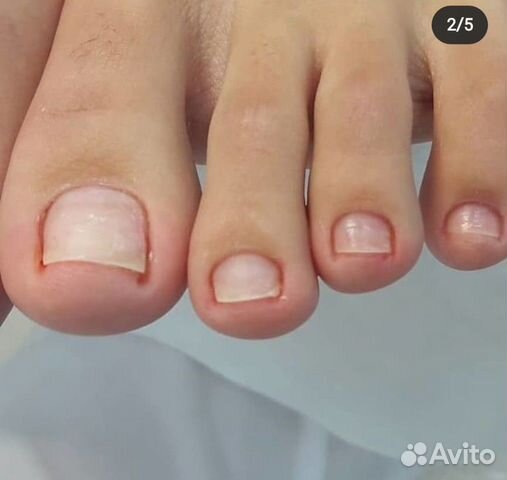 Медицинский педикюр вросший ноготь