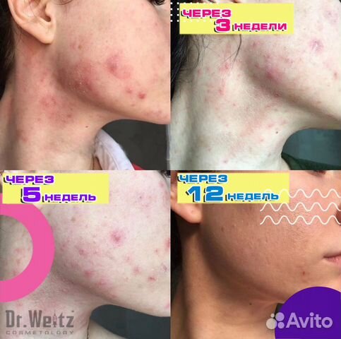 Чистка лица Dr. Weitz Cosmetology